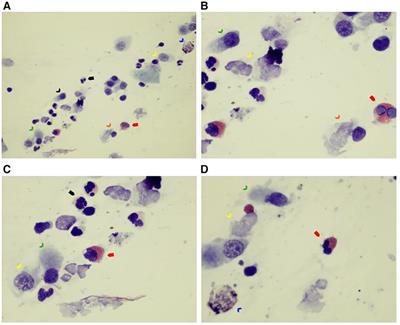 A novel mutation in GAS8 gene associated with chronic rhinosinusitis with nasal polyposis in a case of primary ciliary dyskinesia: a case report